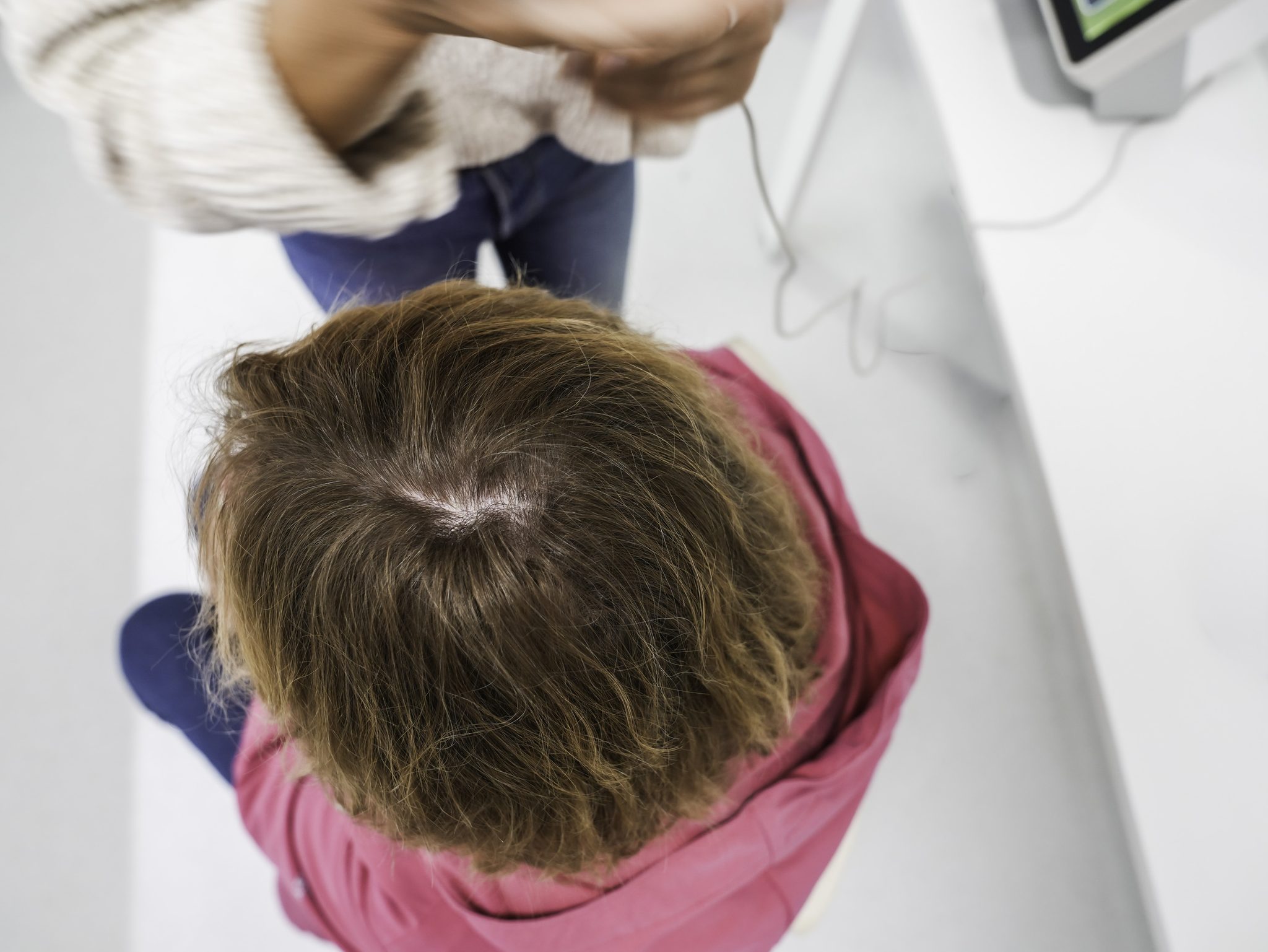 Draufsicht auf die Kopfhaut vor der Messung des Haarwachstums