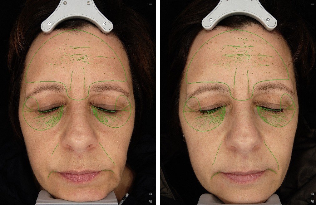 Faltenergebnisse des EVE M Panoramic AI skin analyzer