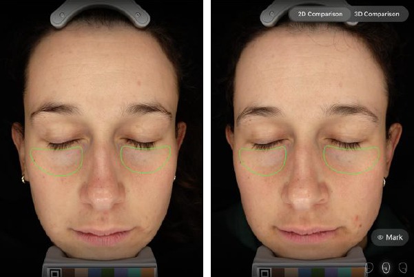 EVE M Ergebnisse zu Augenringen unter den Augen